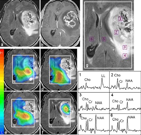 Proton Mr Spectroscopy Of The Brain At T An Update Springerlink