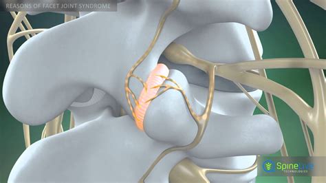 Facet Joint Syndrome Reasons Youtube