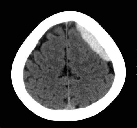 Acute Subdural Hematoma CT Axial 2 JETem 2017 - JETem