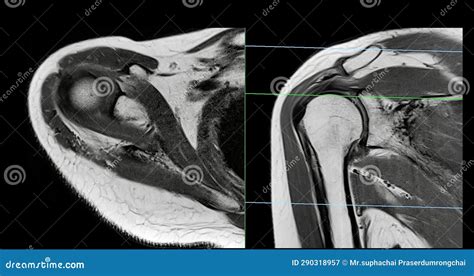 Magnetic Resonance Imaging Or Mri Of Shoulder Joint For Diagnostic