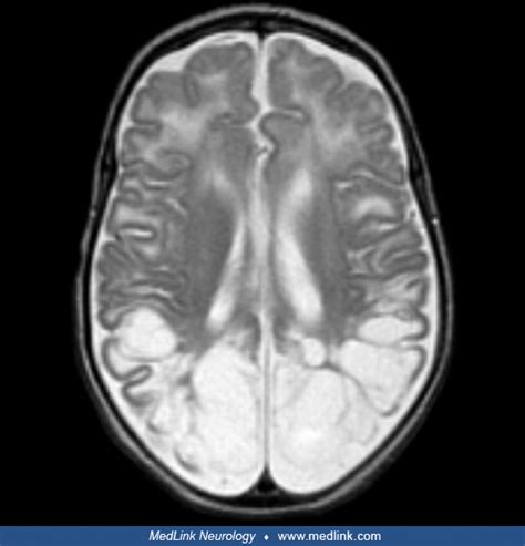 Cortical blindness | MedLink Neurology