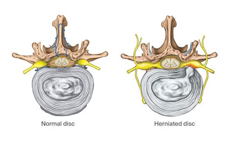 Disk Herniation Flashcards Quizlet