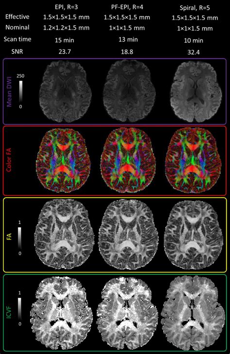 PDF High Resolution Diffusion Weighted Imaging At 7 Tesla Single