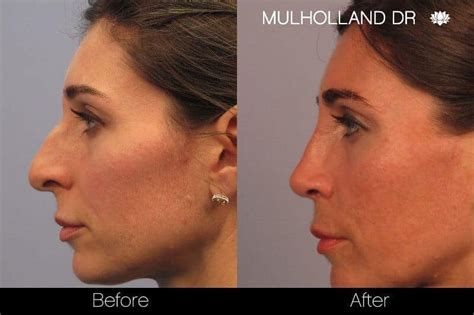 Rhinoplasty For Bulbous Nose Tip Causes Treatment