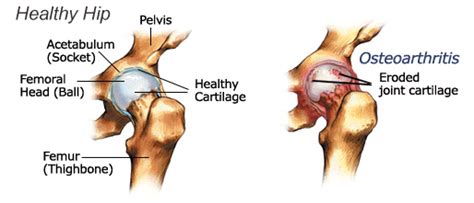 How does hip arthritis develop?