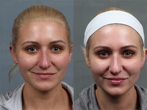 Excel V Laser Treatment Before After Photo Gallery Louisville KY