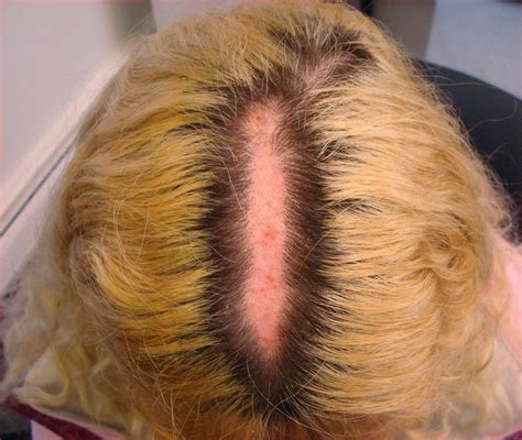 Heartwarming Info About How To Treat Chemical Scalp Burns Matehope54