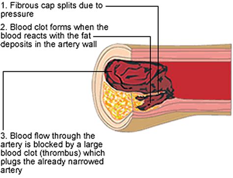 Claudication - Intermittent Claudication Causes, Symptoms & Treatment