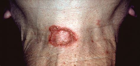 Erythematous Plaques On The Flexural Surfaces—quiz Case Dermatology Jama Dermatology The