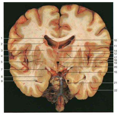 Coronal Cross Section Of Brain Diagram Quizlet