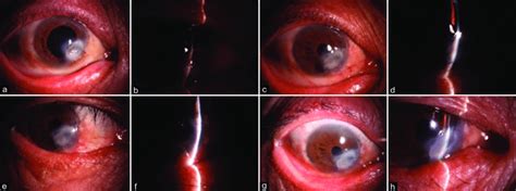 Preoperative And Postoperative Corneal Conditions In Corneal Ulcer Download Scientific Diagram