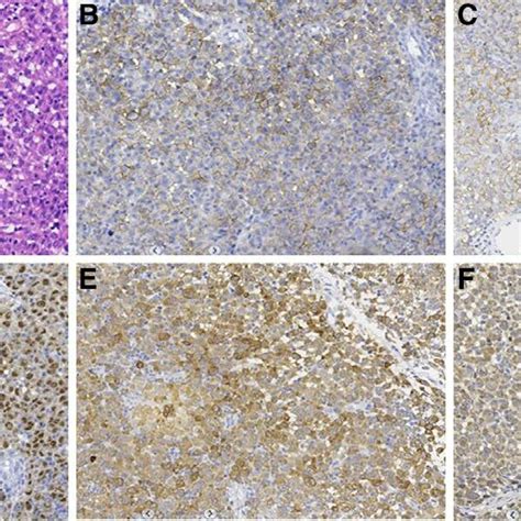 A Hematoxylin Eosin Staining Showed That The Tumor Cells Were