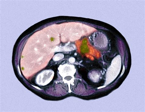 Metastatic Pancreatic Cancer, Ct Scan Photograph by Du Cane Medical Imaging Ltd - Pixels