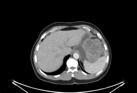 Gastrointestinal Stromal Tumor Gist Pet Ct Image Radiopaedia Org