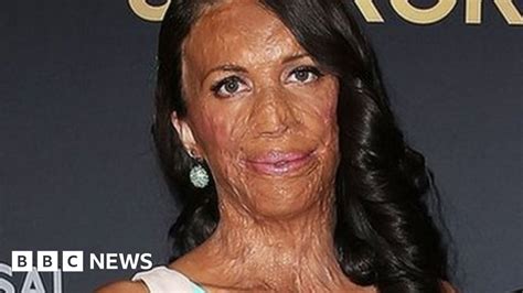 Australian Burns Survivor Turia Pitt Completes Triathlon Bbc News