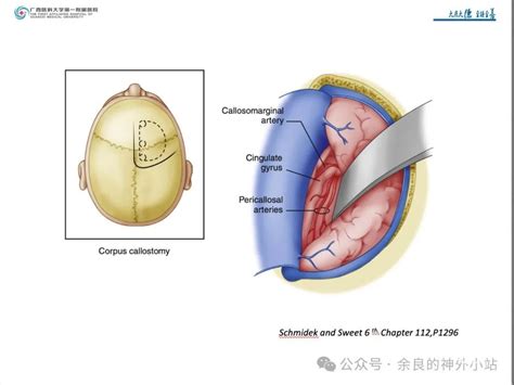 纵裂入路及镰旁脑膜瘤的手术治疗 脑医汇 神外资讯 神介资讯