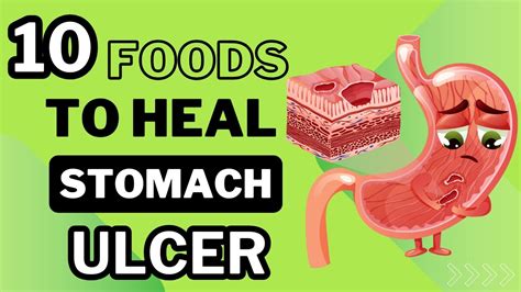 10 Foods To Heal Stomach Ulcers Ulcer Diet Food List Youtube