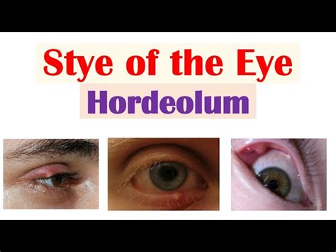 Hordeolum Vs Chalazion