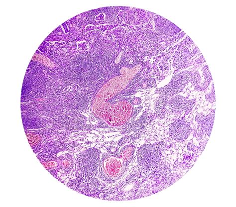 Premium Photo | Photomicrograph of stomach adenocarcinoma. gastric
