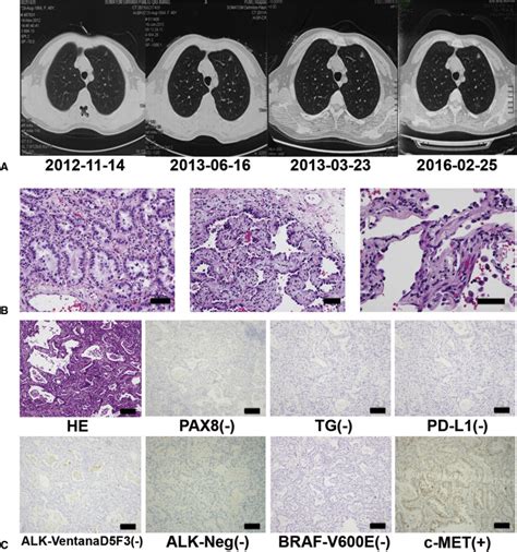 Sequencing A Super Multiple Synchronous Lung Cancer Reveals A Novel Variant In Driver Gene