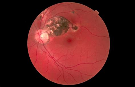 Optometry Atlas Uvea Viewpoint