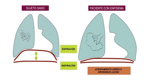 Enfisema Pulmonar