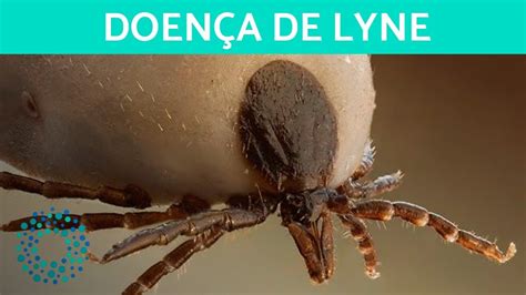 O que é DOENÇA DE LYME Causas sintomas e tratamento YouTube