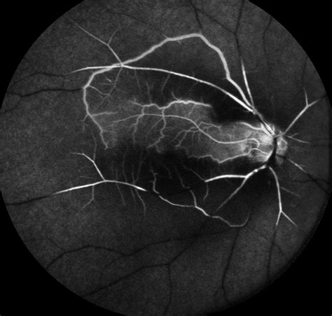 Retinal Artery Occlusion Causes Symptoms Diagnosis Treatment Rxharun