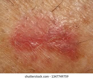 55 Squamous Carcinoma In Situ Images Stock Photos Vectors Shutterstock