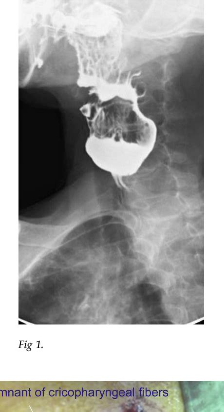 Figure From Perioperative Images Of Cricopharyngeal Achalasia