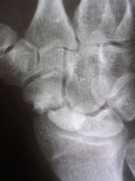 Scaphoid Non Union SNU In Patient Number 3 A Preoperative Radiograph