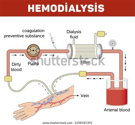 Vector Illustration Hemodialysis Device 스톡 벡터 로열티 프리 1248585301