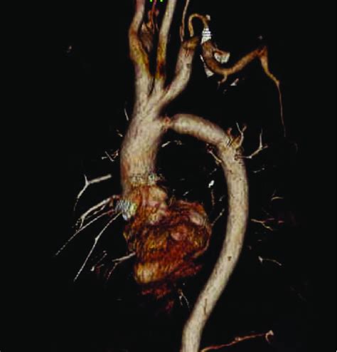 Postoperative Three Dimensional Computed Tomography 3d Ct The Graft Download Scientific