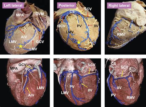 Great Cardiac Vein Cadaver