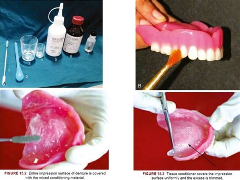 Relining And Rebasing In Complete Dentures Ppt