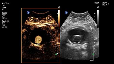 Ceus Contrast Enhanced Ultrasound Philips