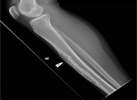 Fibrous Dysplasia MRI