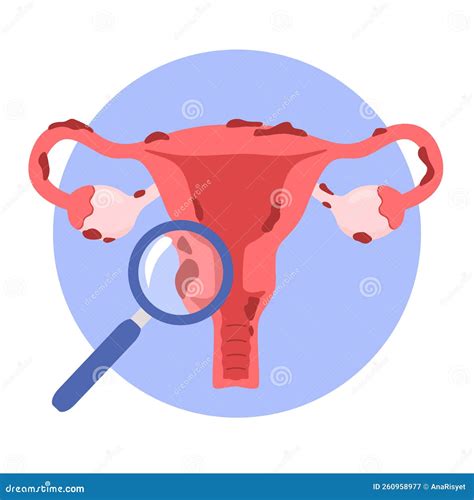 Uterus Endometriosis Diagram Vector Illustration