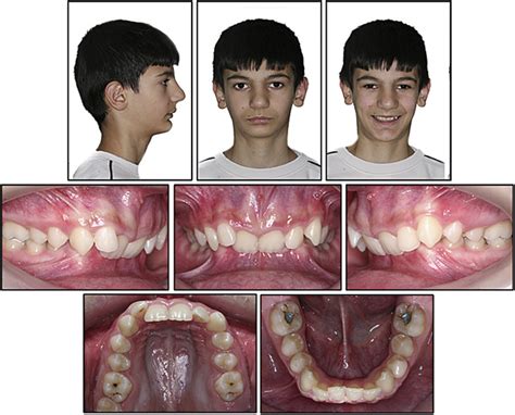 Combined Orthodontic Orthopedic Treatment Of An Adolescent Class Ii