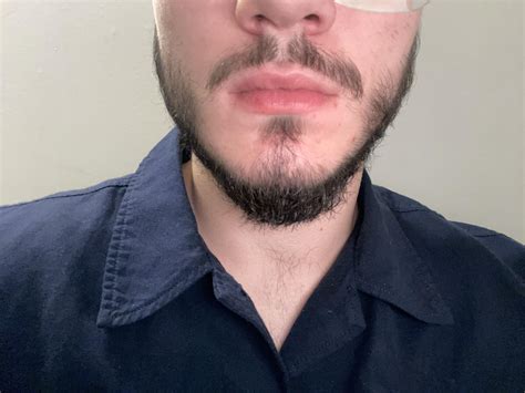 18 Years Old And Tried For The First Time To Grow My Beard Help And