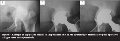 The Results Of A Cementless Acetabular Component Combined With