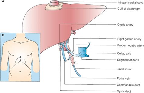 Hepatic Transplantation Basicmedical Key