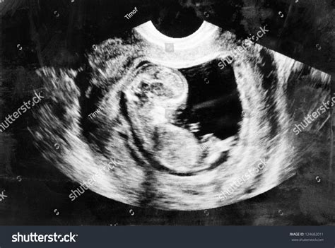 8,323 Ultrasound Imaging Baby Images, Stock Photos & Vectors | Shutterstock