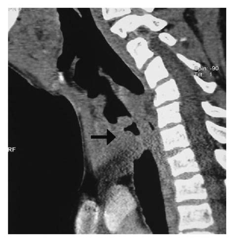 Ct Scan Image Of The Neck Axial Section A Demonstrating An Download Scientific Diagram