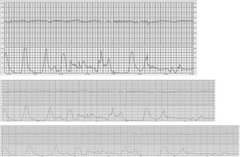 Figo Consensus Guidelines On Intrapartum Fetal Monitoring Cardiotocography Ayres‐de‐campos