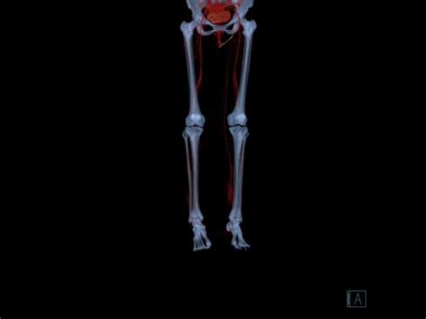 Ct Venography A Spiral Ct Scan Can Be Made With T Tumbex