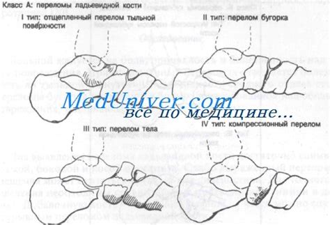 Виды переломов пяточной кости - механизмы