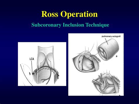 PPT - Ross Operation PowerPoint Presentation, free download - ID:4813686