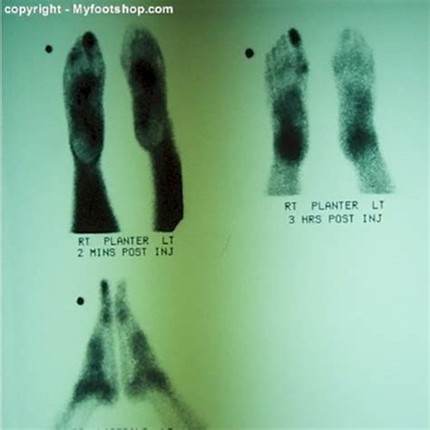 Sesamoid Fractures | Causes and treatment options | MyFootShop.com