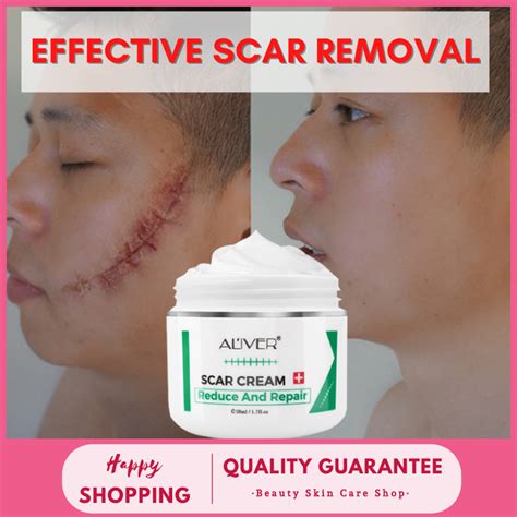 【ready Stock In Manila】aliver Effective Scar Remover Cream For New Old